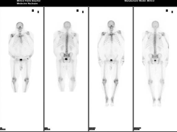 Étude de gauche fait sur la caméra NM/CT 870 CZT avec temps d'acquisition écourté. À droite même patient quelques mois plutôt mais fait sur camera traditionnel NaI.